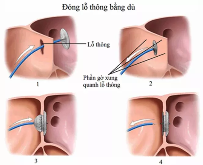 Phẫu thuật bít lỗ thông bằng dù trong điều trị thông liên nhĩ.webp